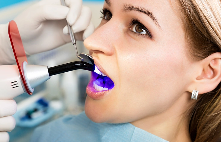 Benefits of White Tooth Fillings in London