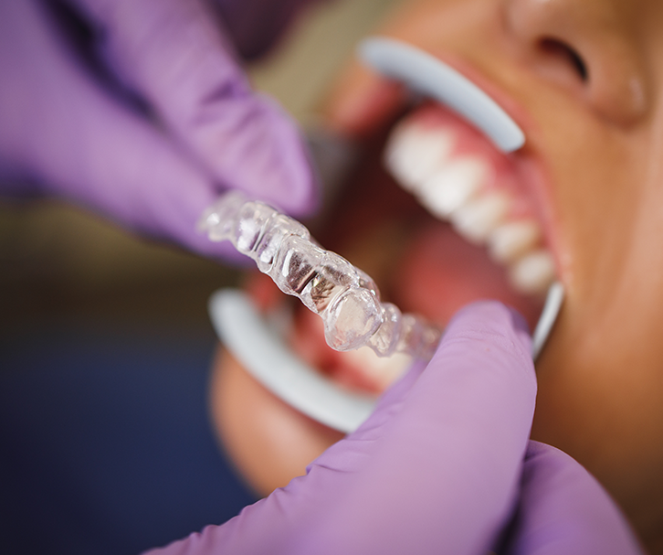 Moderate Invisalign treatment in London explained - Art Dentistry Clinic