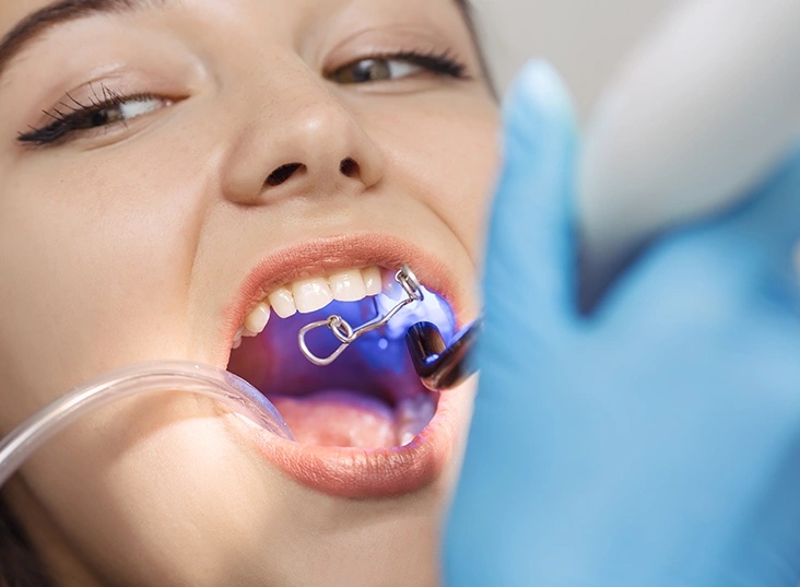 Prepare your teeth surface for composite bonding at art dentistry