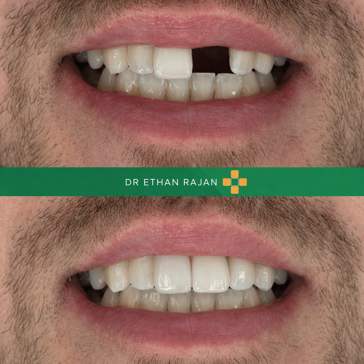 Before and after composite bonding treatment closing gaps between front teeth