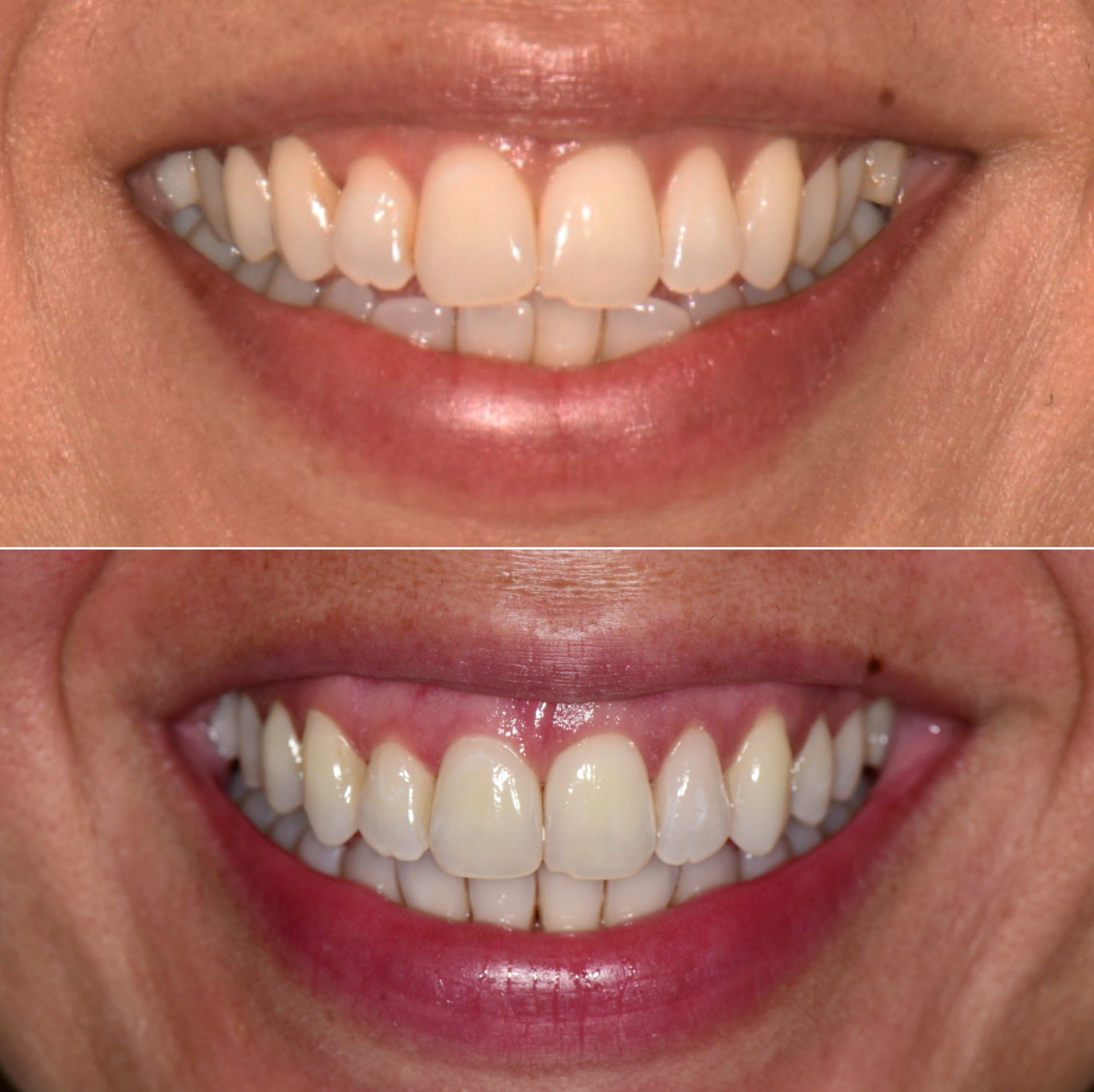 Before and after composite bonding treatment repairing chipped and uneven front teeth